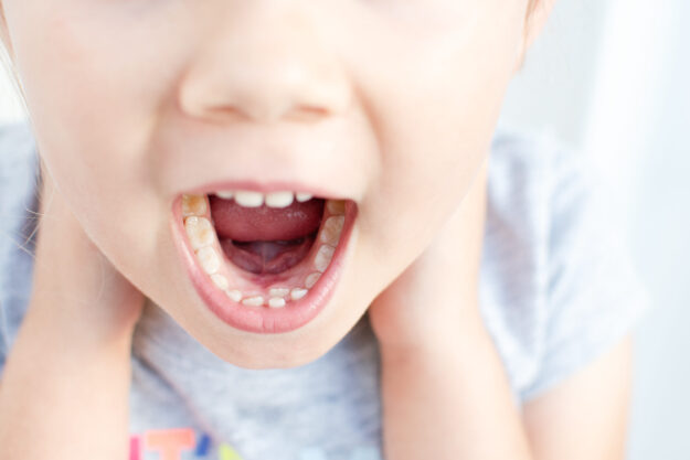 Adult permanent teeth coming in front of the child’s baby teeth: shark teeth. Little girl’s open mouth. Orthodontic Treatment in Louisville crooked teeth