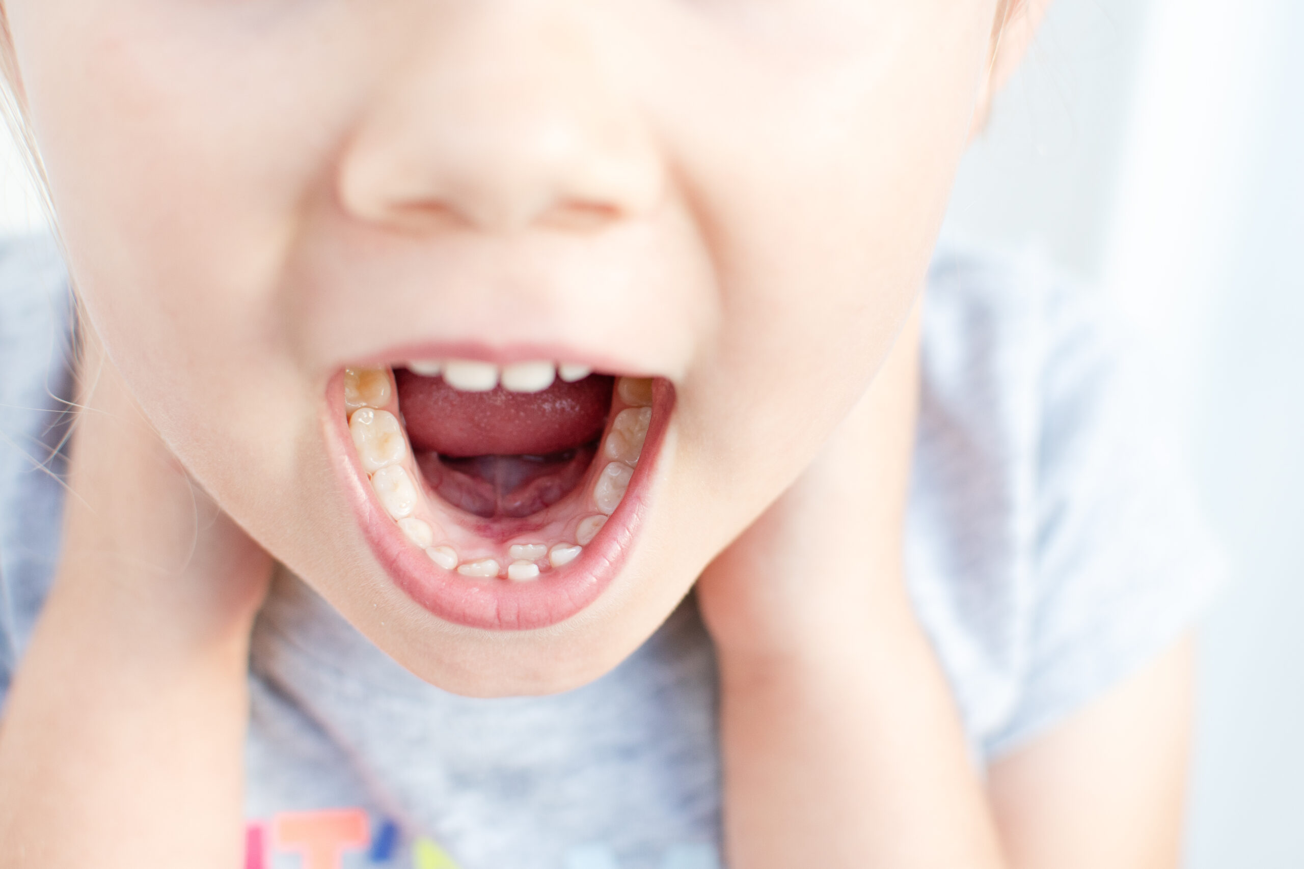 What Causes Crooked Teeth to Develop Over Time? - Magnolia Dental | Dentist in Louisville KY - crooked teeth,orthodontic treatment in Louisville Orthodontic Treatment in Louisville crooked teeth