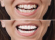 veneers