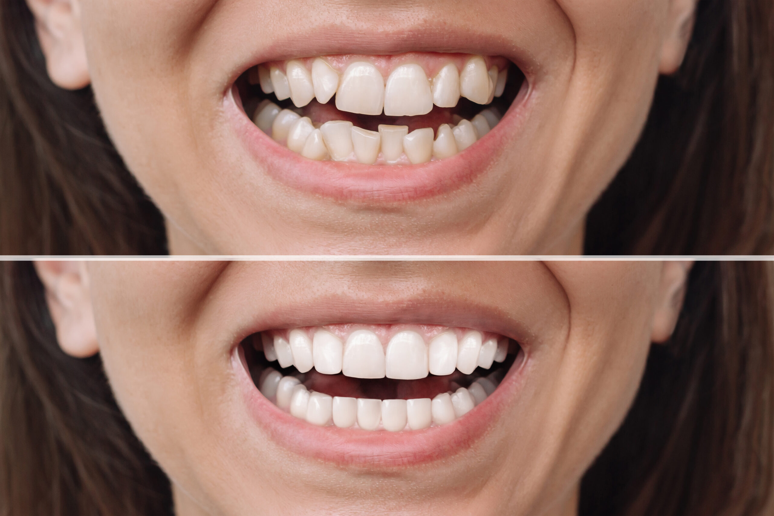 Veneers vs. Dental Bonding: Which Is Better for Your Smile? - Magnolia Dental | Dentist in Louisville KY - veneers veneers